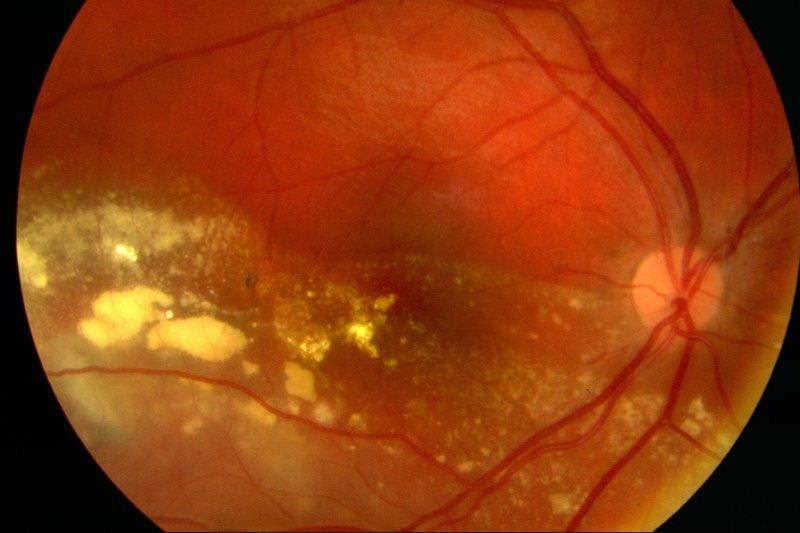 Primary retinal telangiectasia