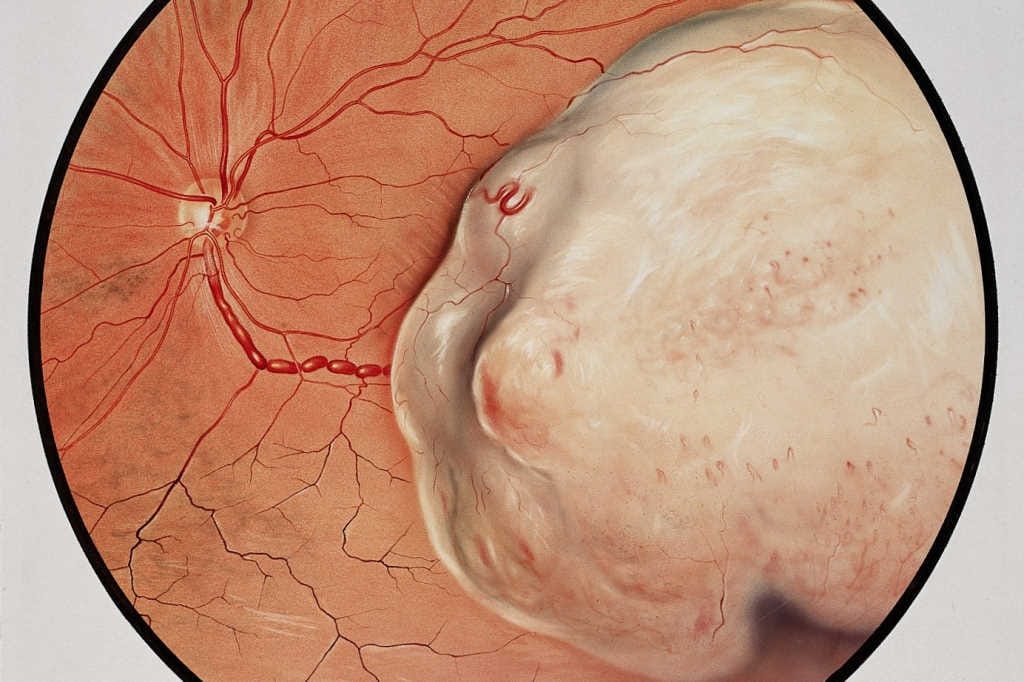 Choroidal melanoma treatment advances