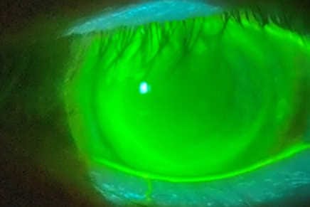 New post-surgery lens for irregular-cornea patients