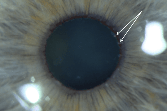 Oh no, the drain is blocked! PXF and glaucoma (1)