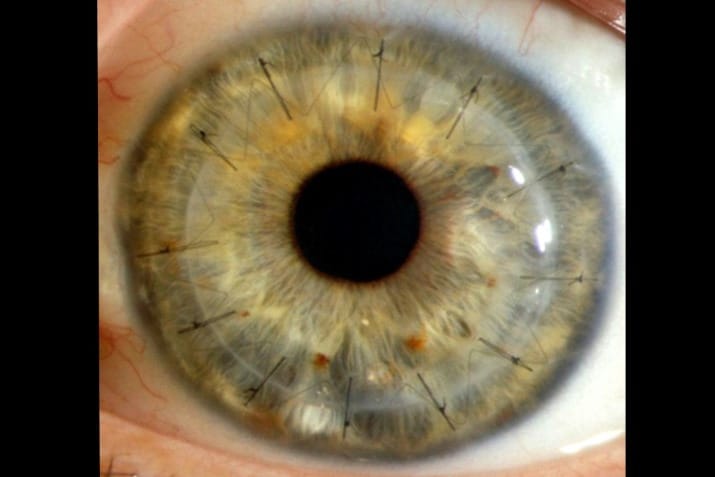 Eye Donation: factors that affect donation rates in Aotearoa New Zealand