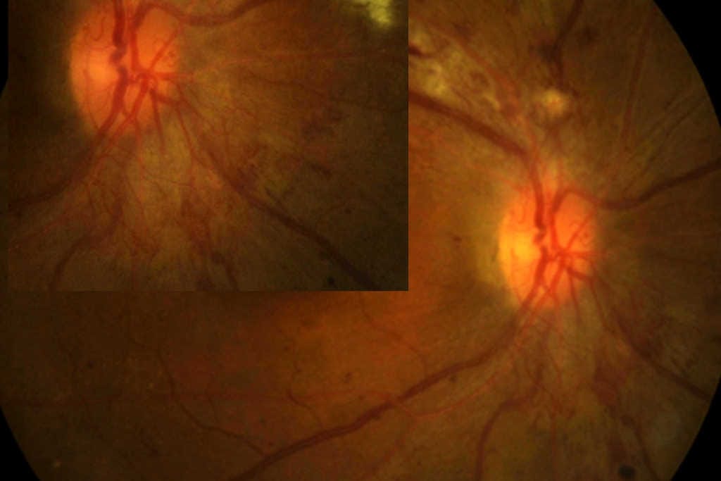 Asymmetric diabetic retinopathy