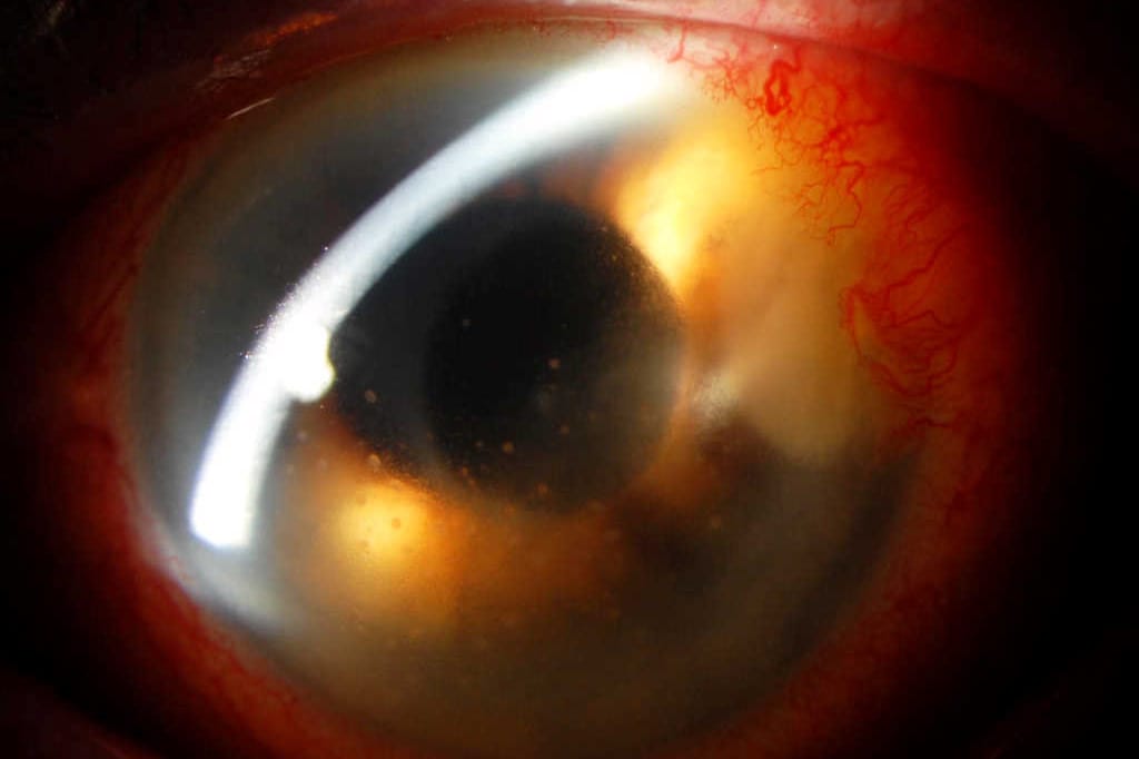 A rare case of Mycobacterium chelonae keratitis