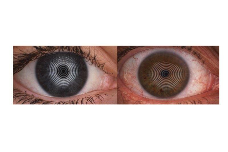 New study to evaluate the best method of assessing ocular inflammation in DED