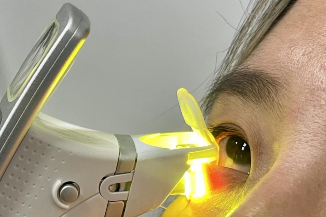 Handheld thermal pulsation promise for MGD