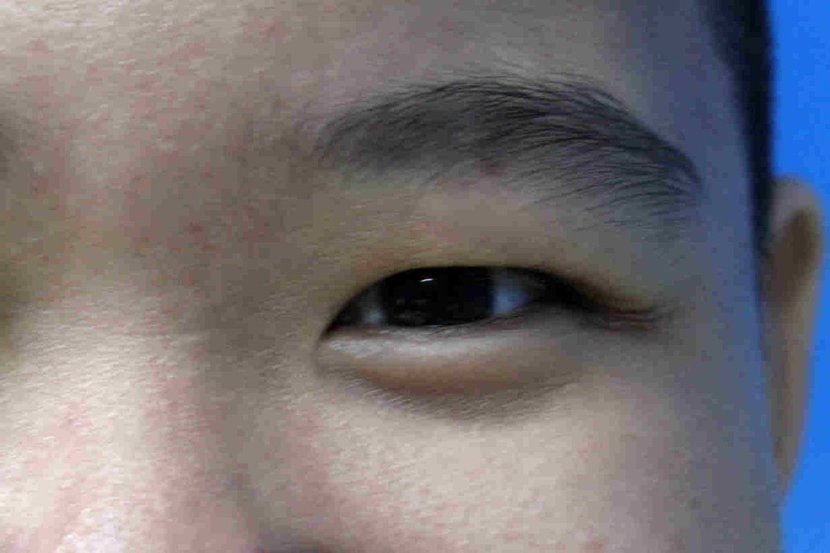 Myopia progression not due to IOP?