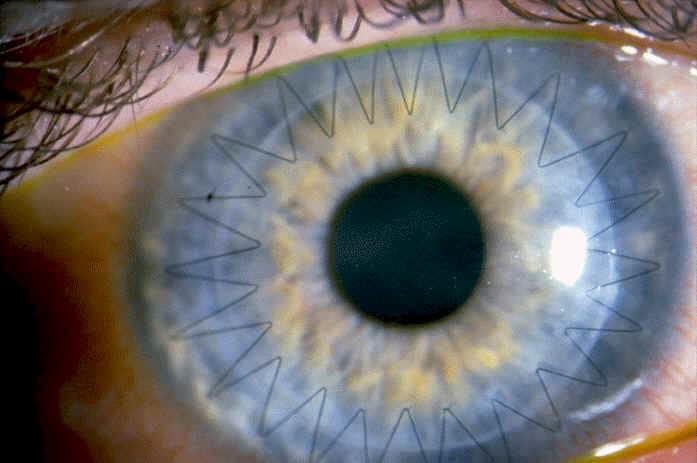 Unravelling Aotearoas low corneal donation rates