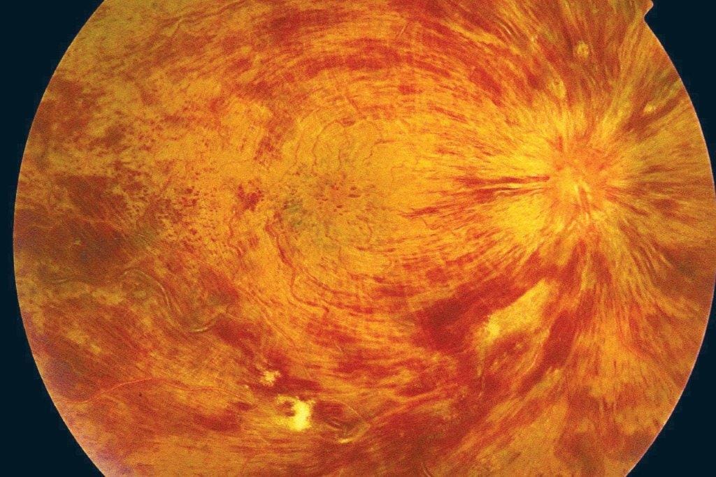 CRVO: 3-year anti-VEGF outcomes