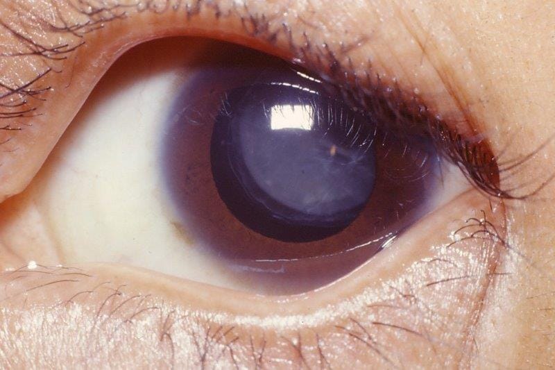 A close eye on Marfan syndrome (1)