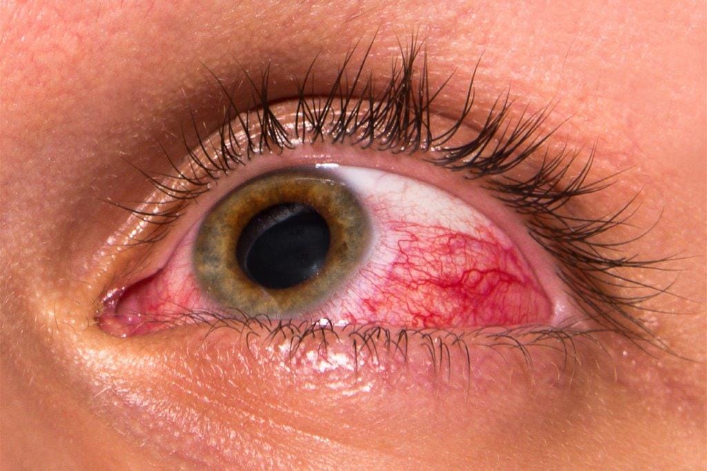 Vitamin D’s role in uveitis under the microscope