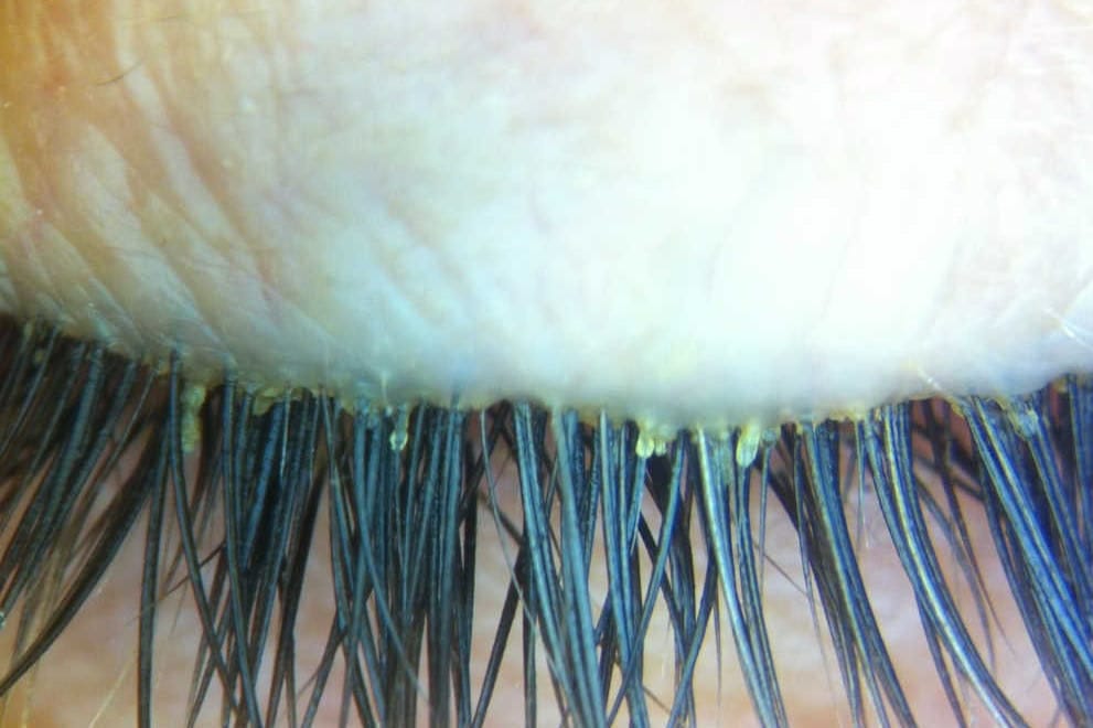 OSL: Demodex research update