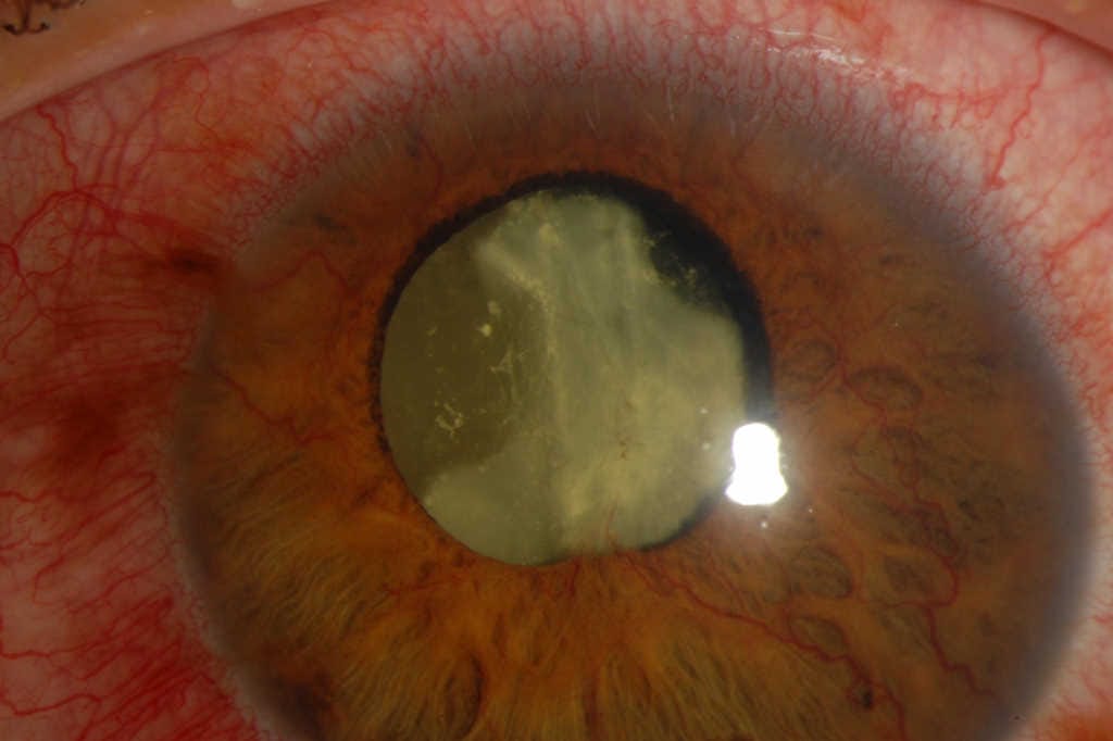 Nutrition and diabetic retinopathy: a path to sight-saving changes