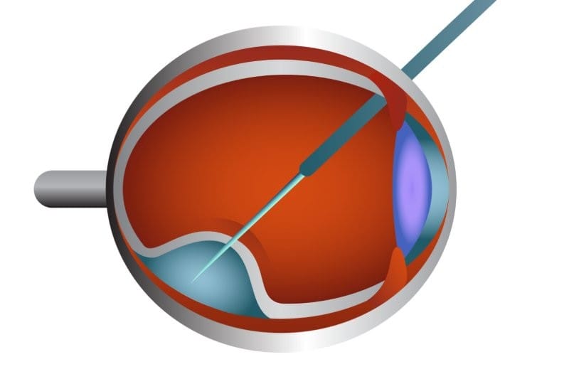 Worlds first remote subretinal injection