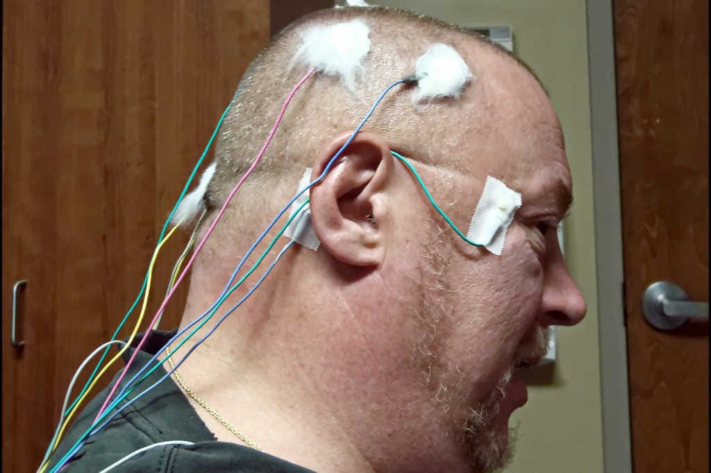 Electrical stimulation reduces CBS hallucinations