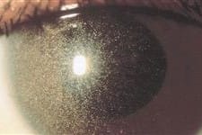 FDA approves drop for ocular cystinosis