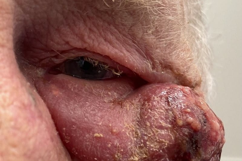 Rare report of orbital pyoderma gangrenosum