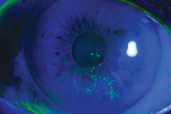Herpes zoster ophthalmicus, uveitic glaucoma, and more