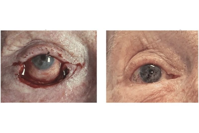 A novel reconstructive surgery for lower eyelid defects