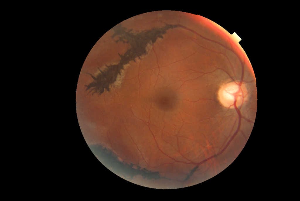 Early red flags for adult pathologic myopia