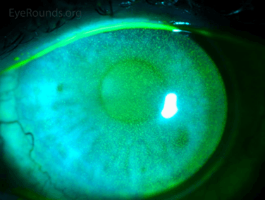 CASE STUDY: The importance of spotting microtremors (1)