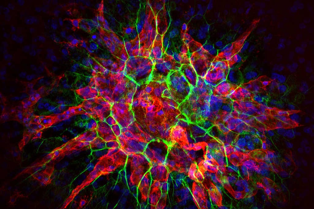 Myopic MNV risk factors identified