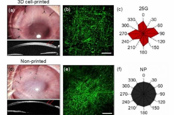 3D-printed cornea breakthrough
