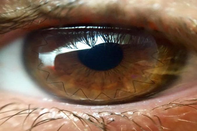 Australian bioengineered cornea boost