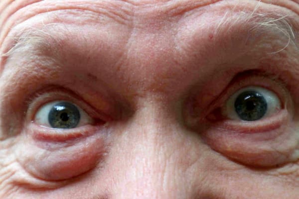 MAR vision loss restored