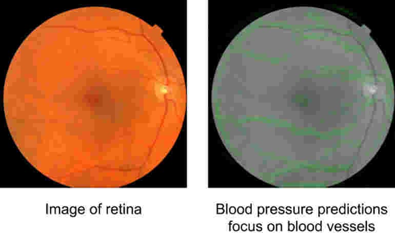 Retina scans and AI detect heart disease