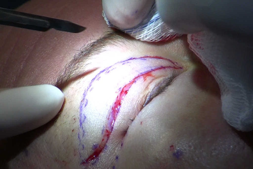 Australia tightens cosmetic surgery rules