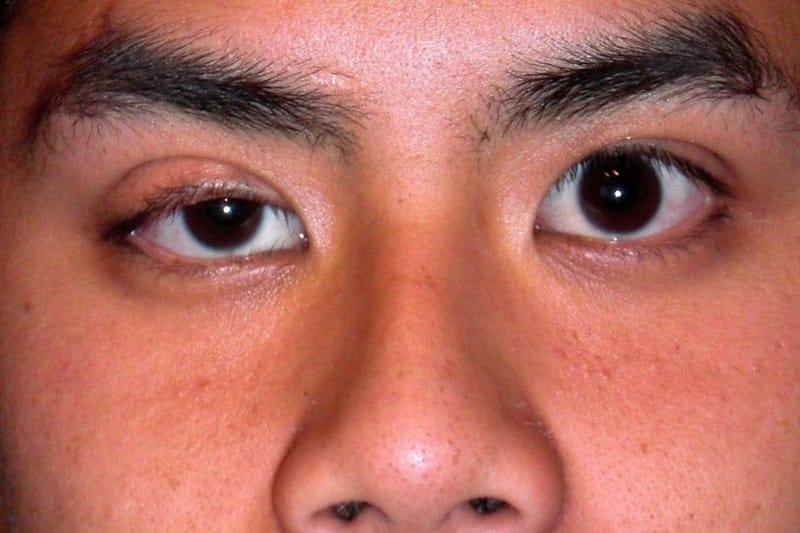 IRIS  measuring ptosis with a single photograph