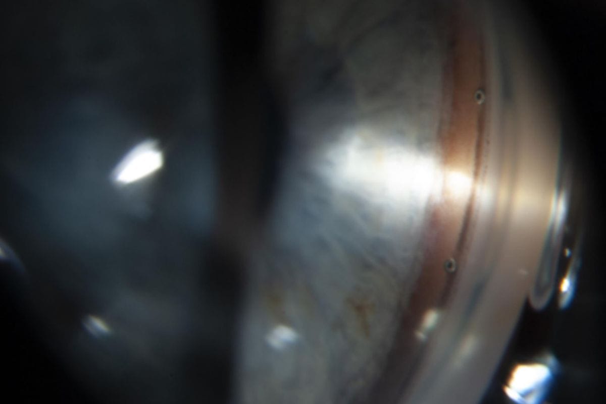 Minimally invasive glaucoma surgery (MIGS) in NZ