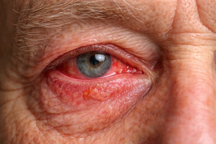 Alzheimers-linked retinal infection