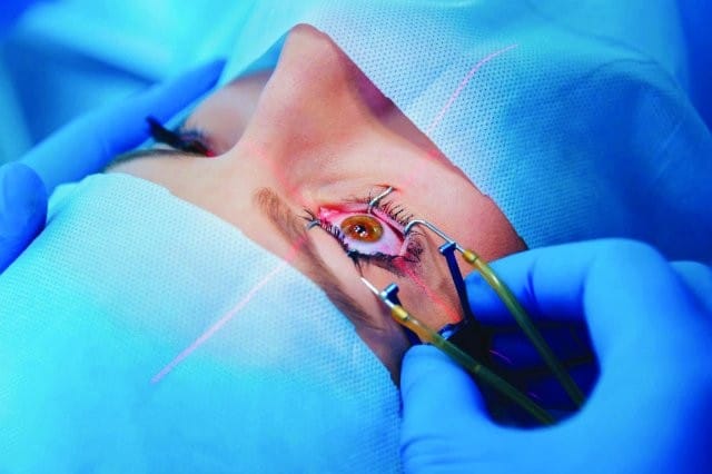 lasik surgery