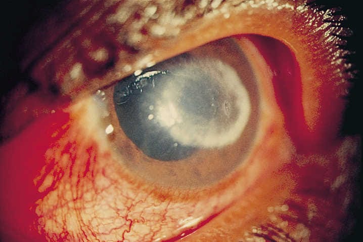 Novel mycotic keratitis treatment