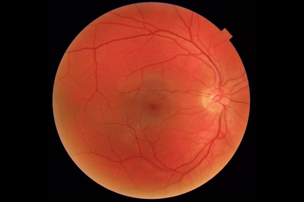 rpmhwekm moorfields fundus online