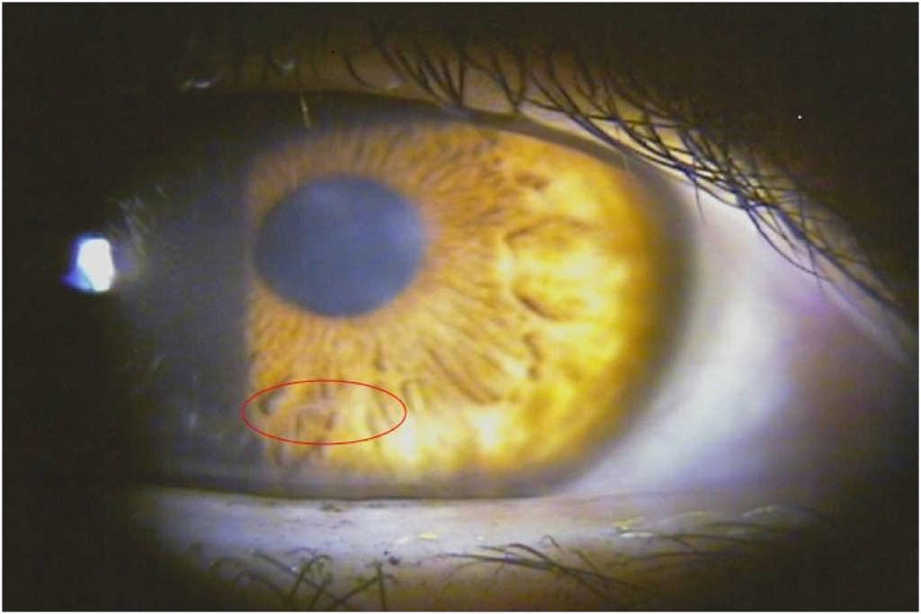 New worm found in eye