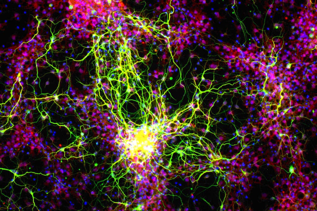 New gene therapy possibility for DR, glaucoma
