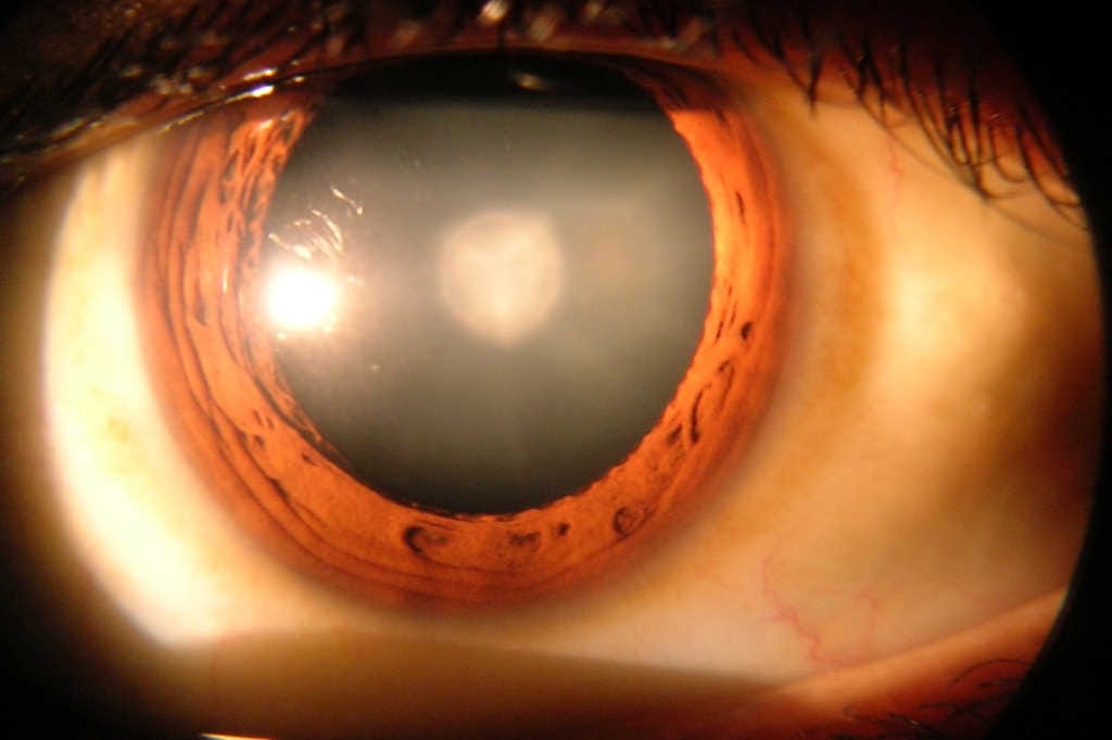 Unravelling life’s effects on the lens