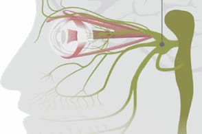 Specs for headaches?