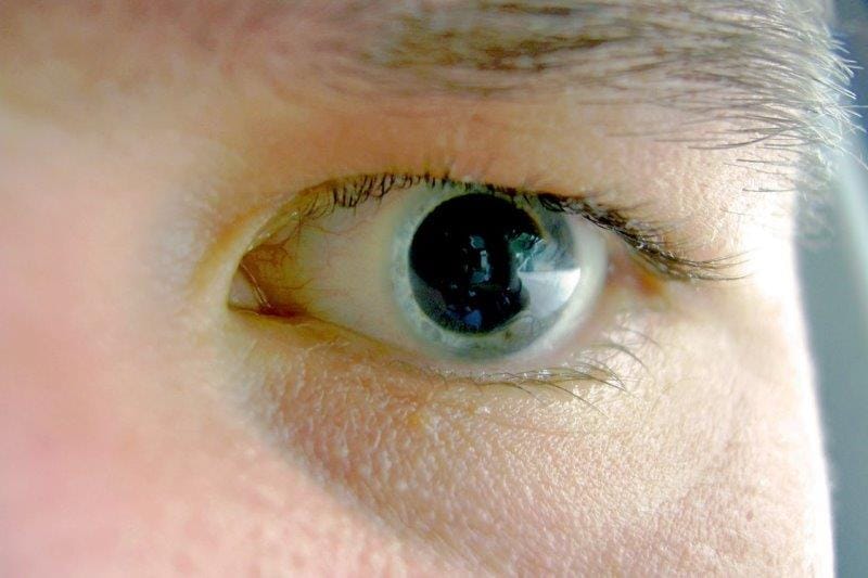 Hope for early keratoconus detection