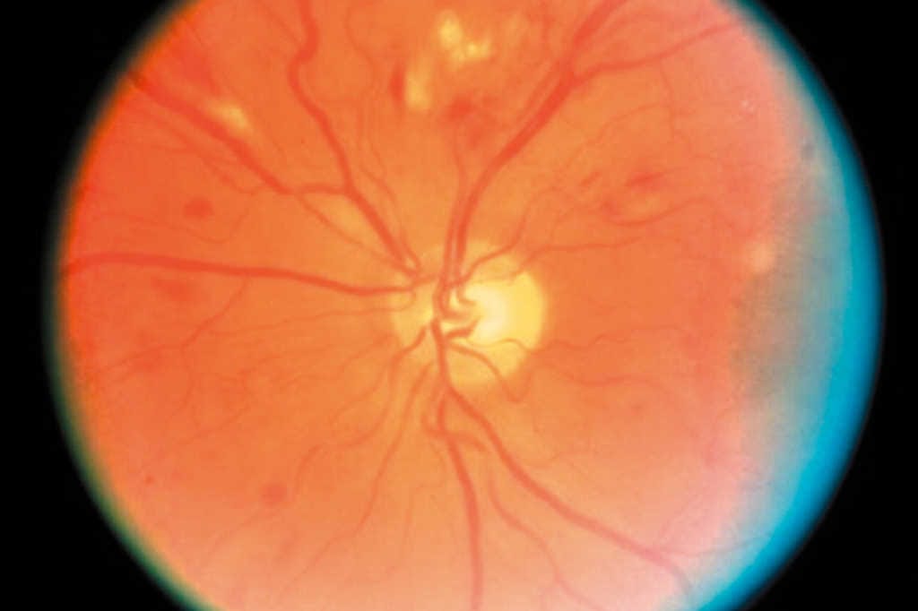 Tick-borne vision issues