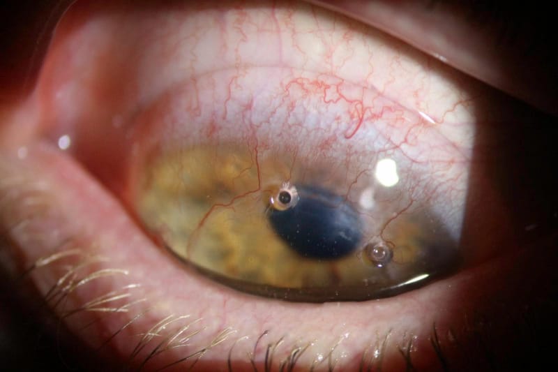 RGPs and corneal graft patients