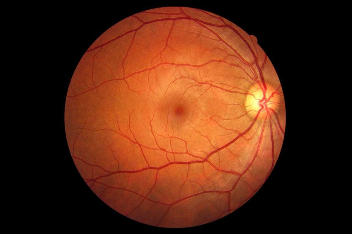 Retinal age gap linked with mortality