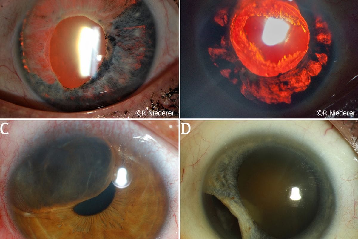 The iris in health and disease, part II: Iris transillumination defects and rubeosis iridis (1)