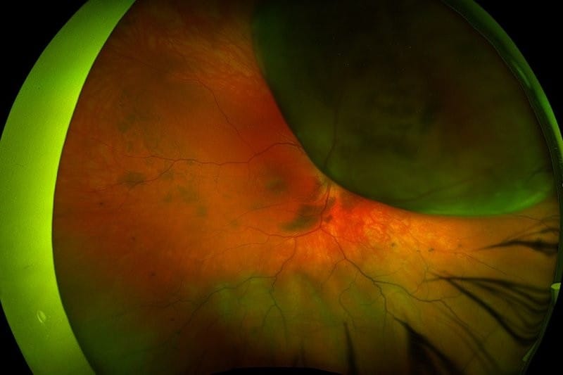 New treatments for uveal melanomas and naevi