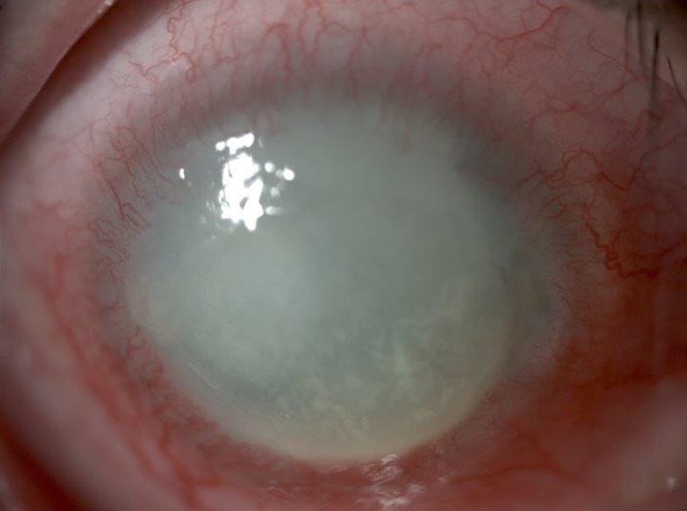 Acanthamoeba meets its match