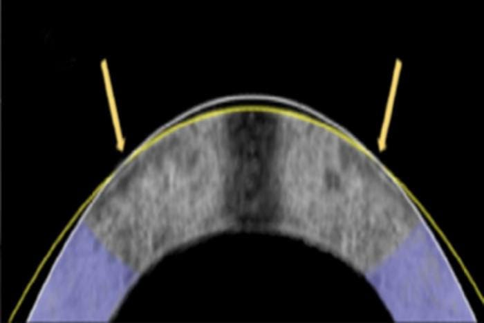 Laser-free corneal reshaping