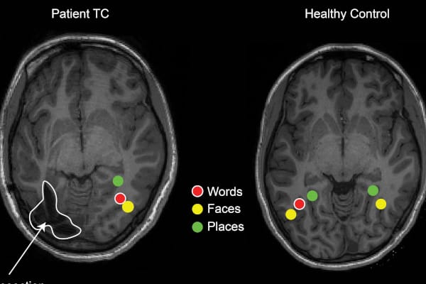 Epileptic kids compensate for lost brain tissue