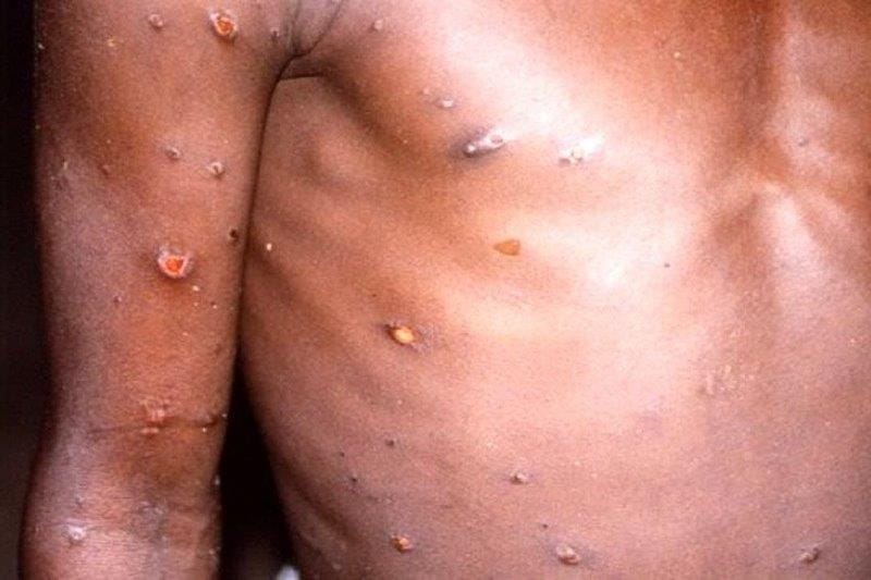 Monkeypox alert for ECPs